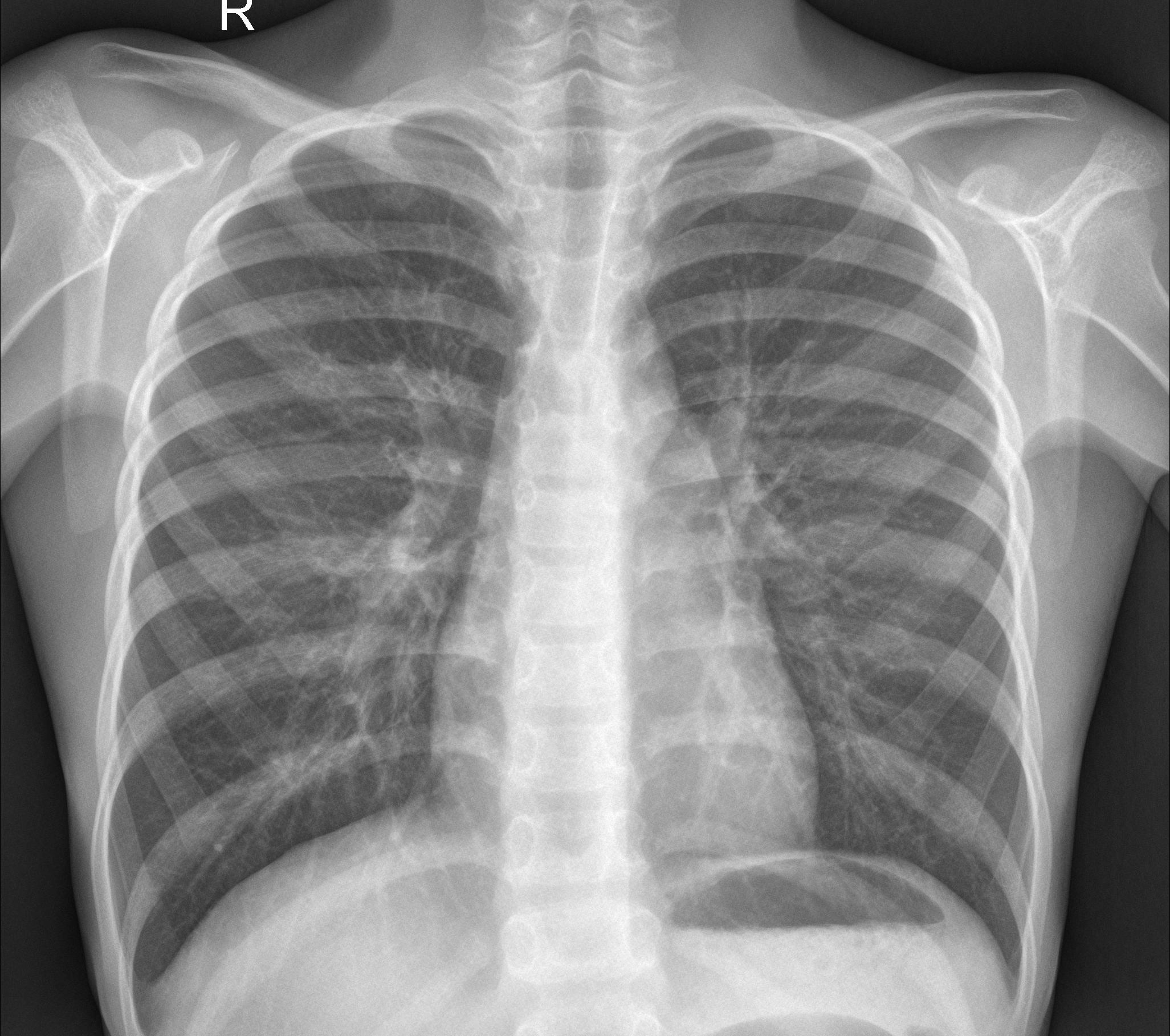chest xray